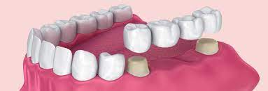 Nagu Super Speciality Dental Clinic - Latest update - Best Crowns Bridges Treatment Channapatana