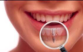 Nagu Super Speciality Dental Clinic - Latest update - COSMETIC DENTAL TREATMENT NEAR CHANNAPATNA