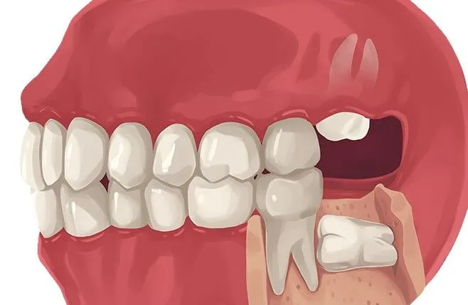 Nagu Super Speciality Dental Clinic - Latest update - WISDOM TEETH REMOVAL IN CHANNAPATNA