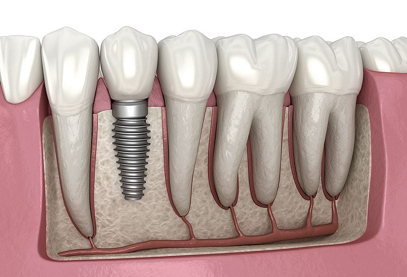 Nagu Super Speciality Dental Clinic - Latest update - DENTAL IMPLANTS IN CHANNAPATNA