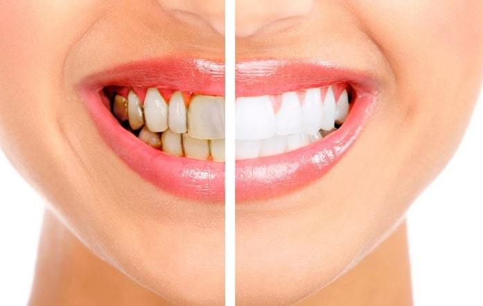 Nagu Super Speciality Dental Clinic - Latest update - TEETH WHITENING TREATMENT NEAR CHANNAPATNA