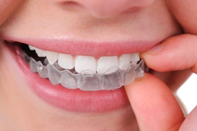 Nagu Super Speciality Dental Clinic - Latest update - BEST INVISIBLE BRACES IN CHANNAPATNA