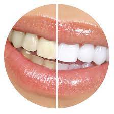 Nagu Super Speciality Dental Clinic - Latest update - Teeth Whitening Treatment Channapatana