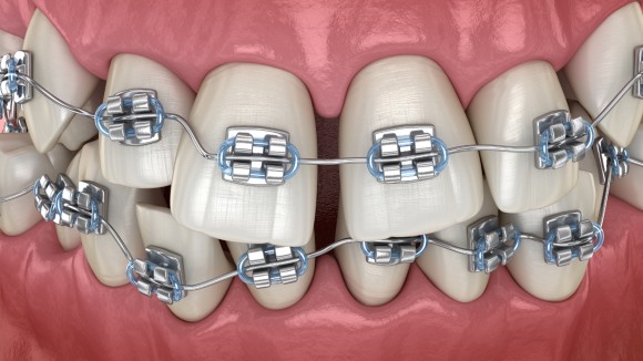 Nagu Super Speciality Dental Clinic - Latest update - Orthodontics Treatment in Channapatana