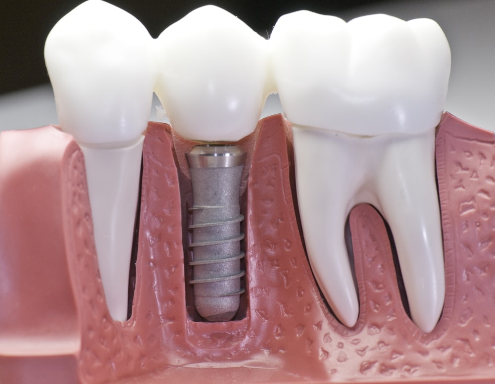 Nagu Super Speciality Dental Clinic - Latest update - Dental Implant Treatment In Channapatna