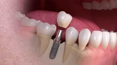 Nagu Super Speciality Dental Clinic - Latest update - DENTAL IMPLANTS TREATMENT NEAR CHANNAPATNA