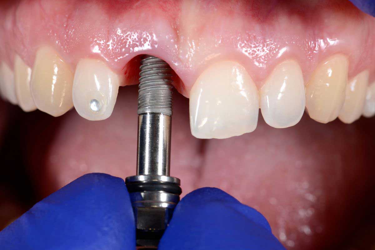 Nagu Super Speciality Dental Clinic - Latest update - Dental Implant Treatments In Channapatna