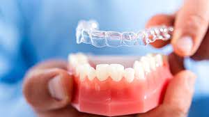 Nagu Super Speciality Dental Clinic - Latest update - INVISIBLE BRACES IN CHANNAPATNA