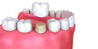 Nagu Super Speciality Dental Clinic - Latest update - DENTAL IMPLANTS TREATMENT IN CHANNAPATNA