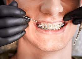 Nagu Super Speciality Dental Clinic - Latest update - Orthodontics Treatment in Channapatana