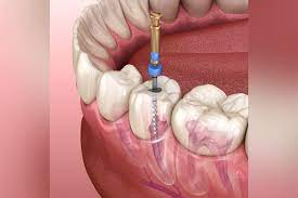 Nagu Super Speciality Dental Clinic - Latest update - Orthodontics Treatment In Channapatana