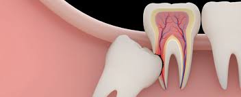 Nagu Super Speciality Dental Clinic - Latest update - Wisdom Teeth Removal Treatment In Channapatana