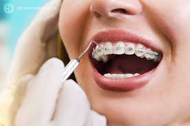 Nagu Super Speciality Dental Clinic - Latest update - ORTHODONTICS IN CHANNAPATNA