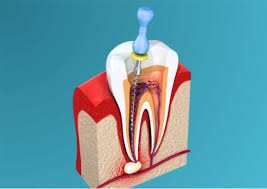 Nagu Super Speciality Dental Clinic - Latest update - Root Canal Treatment in Channapatna