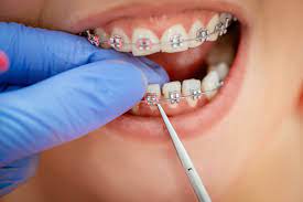 Nagu Super Speciality Dental Clinic - Latest update - Orthodontics Treatment In Channapatana