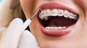 Nagu Super Speciality Dental Clinic - Latest update - Orthodontics Treatment in Channapatana