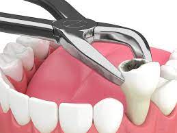 Nagu Super Speciality Dental Clinic - Latest update - Wisdom Tooth Extraction Channapatna