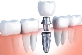 Nagu Super Speciality Dental Clinic - Latest update - DENTAL IMPLANTS TREATMENT IN CHANNAPATNA