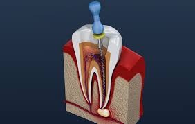 Nagu Super Speciality Dental Clinic - Latest update - Root Canal Treatment In Channaptana