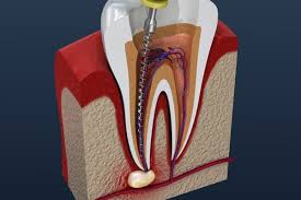 Nagu Super Speciality Dental Clinic - Latest update - ROOT CANAL TREATMENT IN CHANNAPATNA