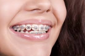 Nagu Super Speciality Dental Clinic - Latest update - ORTHODONTICS TREATMENT IN CHANNAPATNA