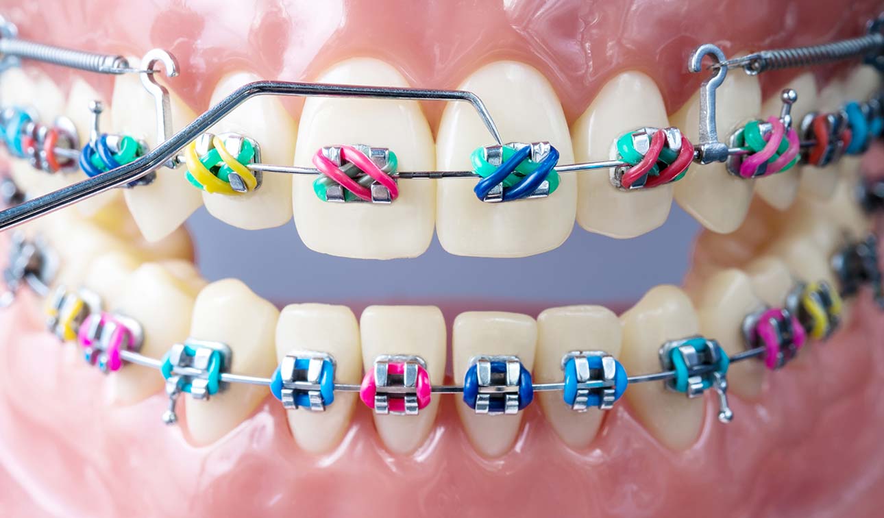 Nagu Super Speciality Dental Clinic - Latest update - ORTHODONTICS IN CHANNAPATANA