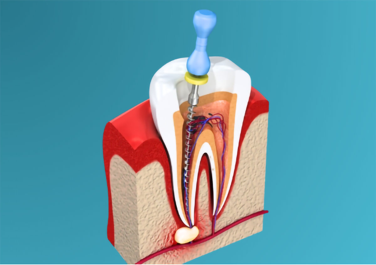 Nagu Super Speciality Dental Clinic - Latest update - Root Canal Treatment In Channaptana