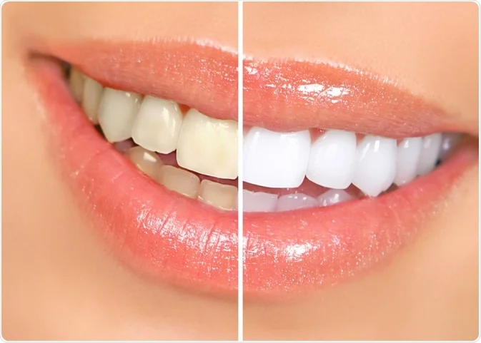 Nagu Super Speciality Dental Clinic - Latest update - TEETH WHITENING IN CHANNAPATNA