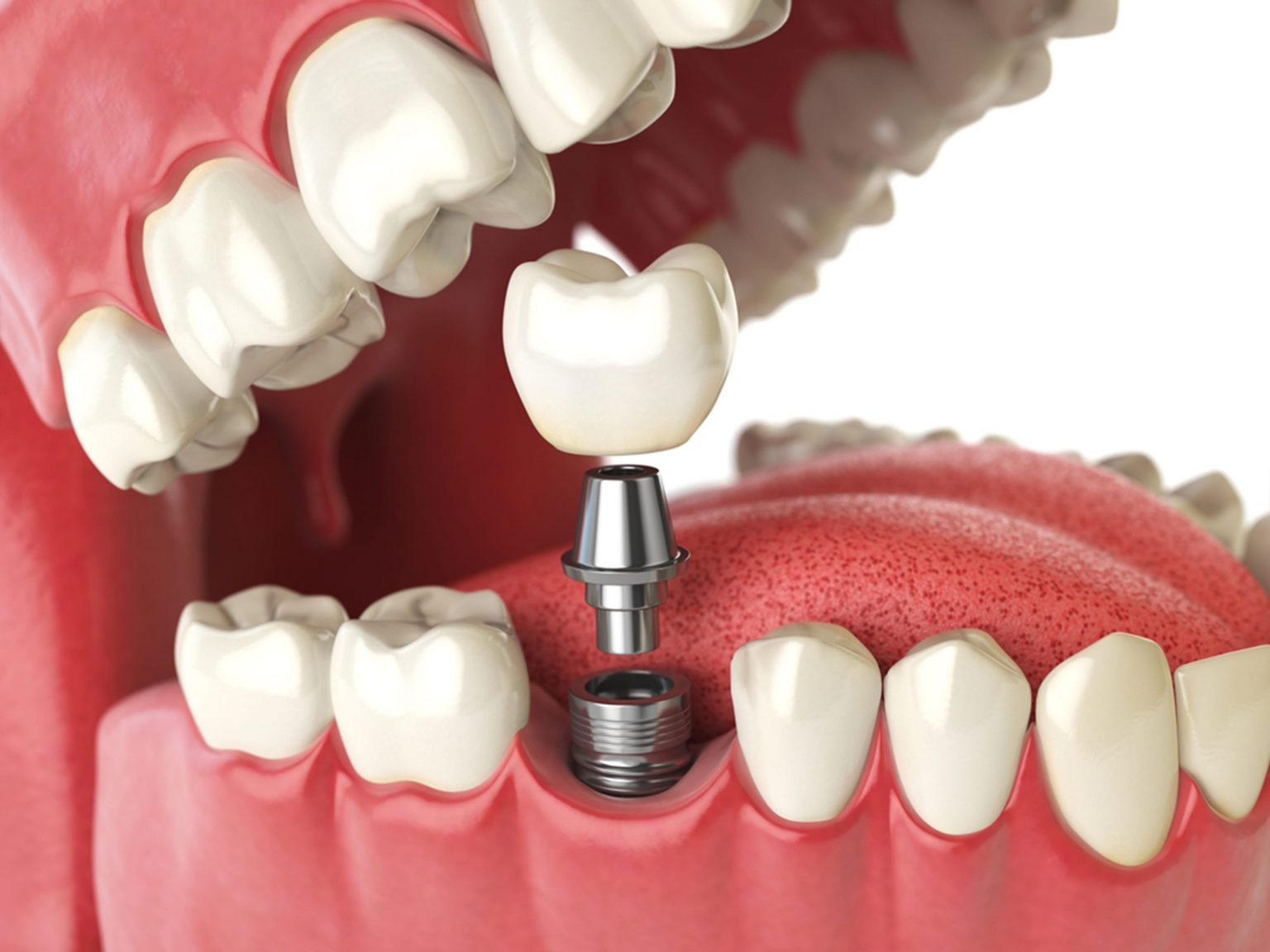 Album - Dental Implants