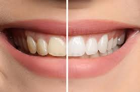 Nagu Super Speciality Dental Clinic - Latest update - Teeth Whitening in Channapatna