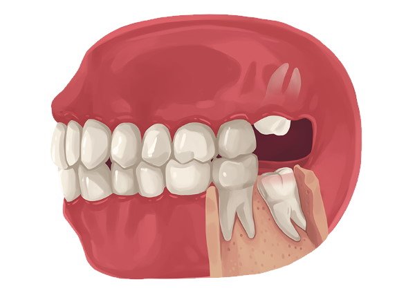 Nagu Super Speciality Dental Clinic - Latest update - WISDOM TEETH REMOVAL IN CHANNAPATANA